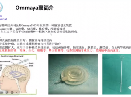 神奇的ommaya囊——学习笔记