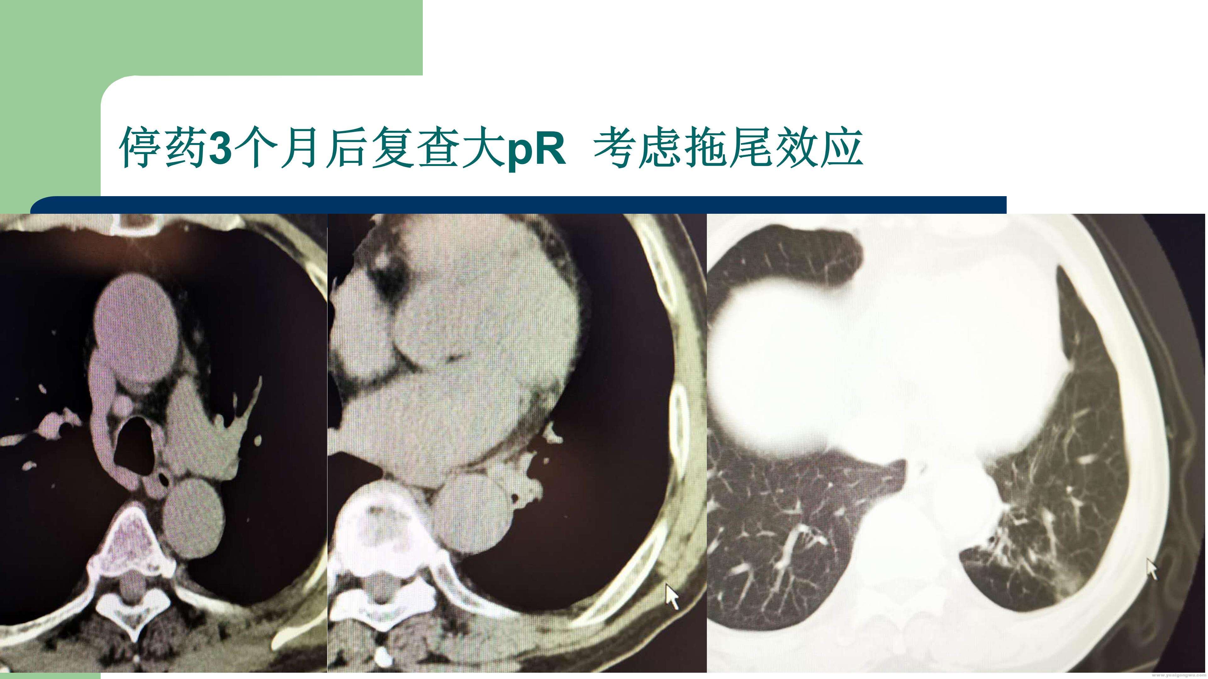 PD1病例分享_17.jpg